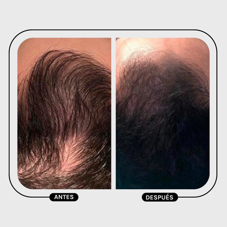 Magic Hair Anti-Hair Loss Men Kit
